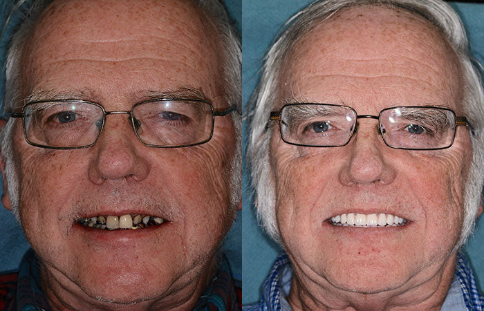 HZA™ Custom-Fit Premium Dentures – Full Set