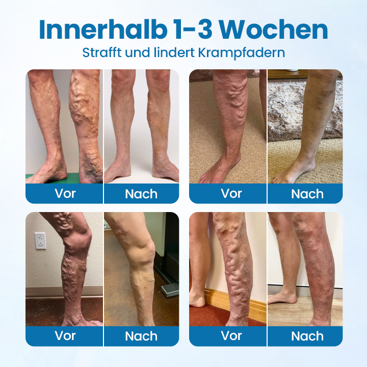 Veinelle® Herbal Spray – Clinically Proven to Visibly Fade Varicose & Spider Veins in Just 7 Days