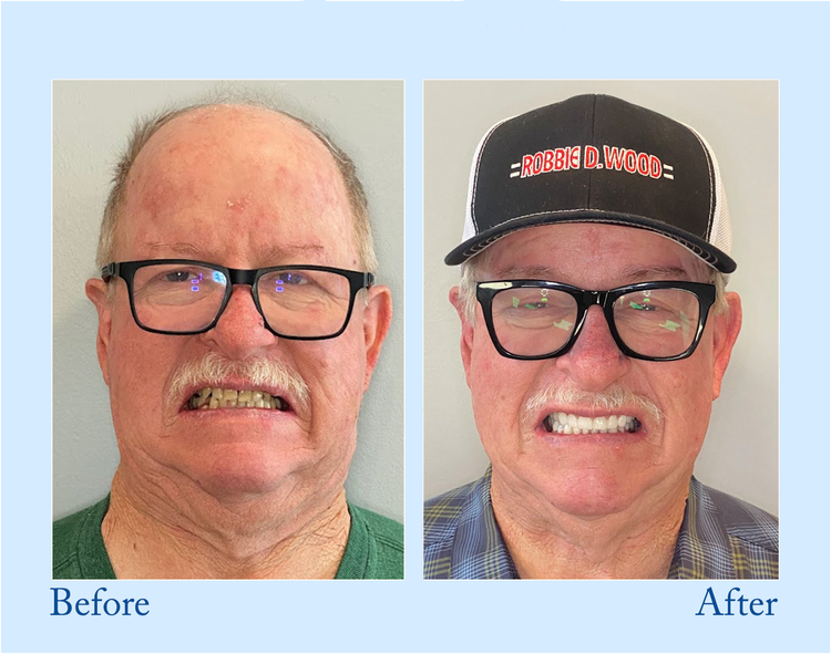 TrueEase™ Custom-Fit Functional Dentures — Perfectly Fitted in Minutes at Home