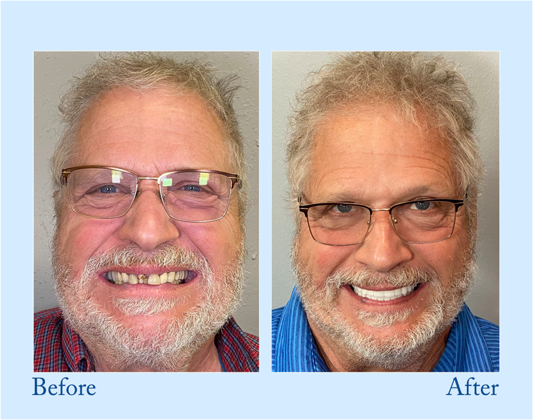 TrueEase™ Custom-Fit Functional Dentures — Perfectly Fitted in Minutes at Home