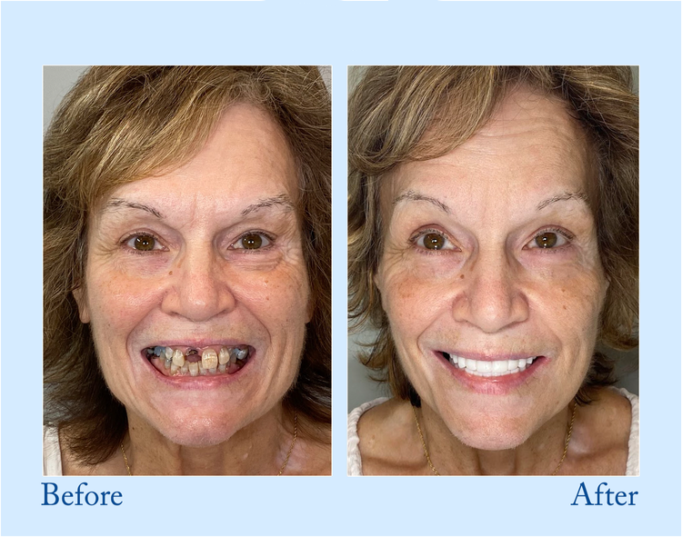 TrueEase™ Custom-Fit Functional Dentures — Perfectly Fitted in Minutes at Home