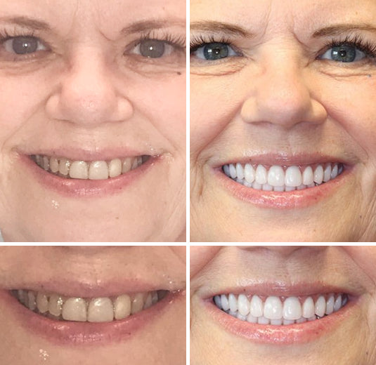 HZA™ Custom-Fit Premium Dentures – Full Set