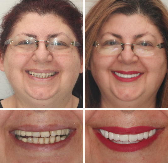 HZA™ Custom-Fit Premium Dentures – Full Set