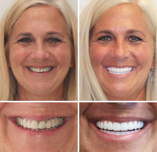 HZA™ Custom-Fit Premium Dentures – Full Set