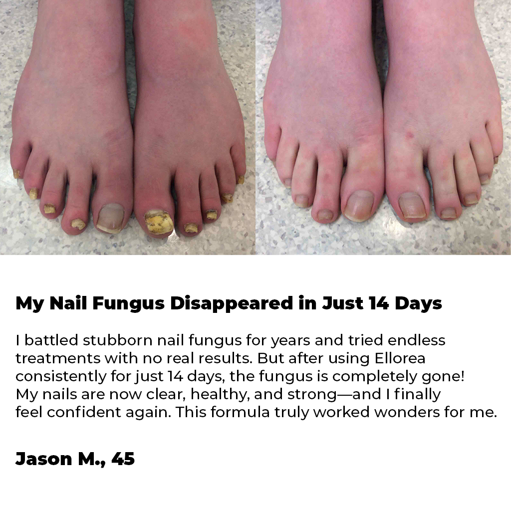 Anti-Fungal Odor Bee Venom Spray