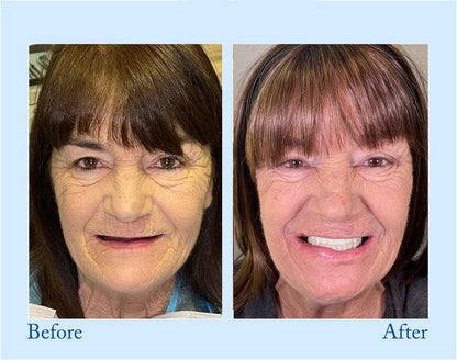 TrueEase™ Custom-Fit Functional Dentures — Perfectly Fitted in Minutes at Home