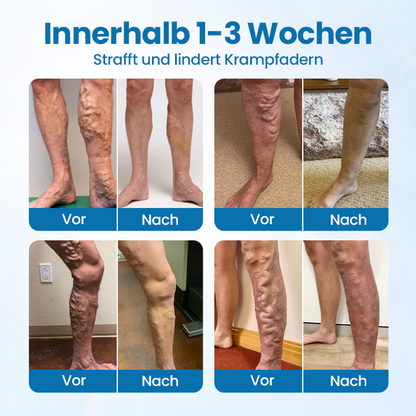 Veinelle® Herbal Spray – Clinically Proven to Visibly Fade Varicose & Spider Veins in Just 7 Days