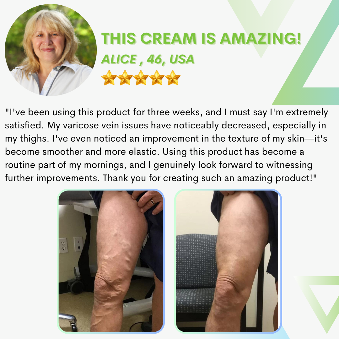 Varicose Vein Cream