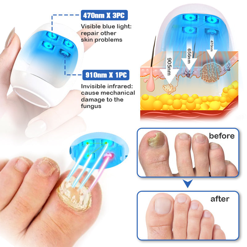 Nail Fungus Cleaning Laser Relief Device