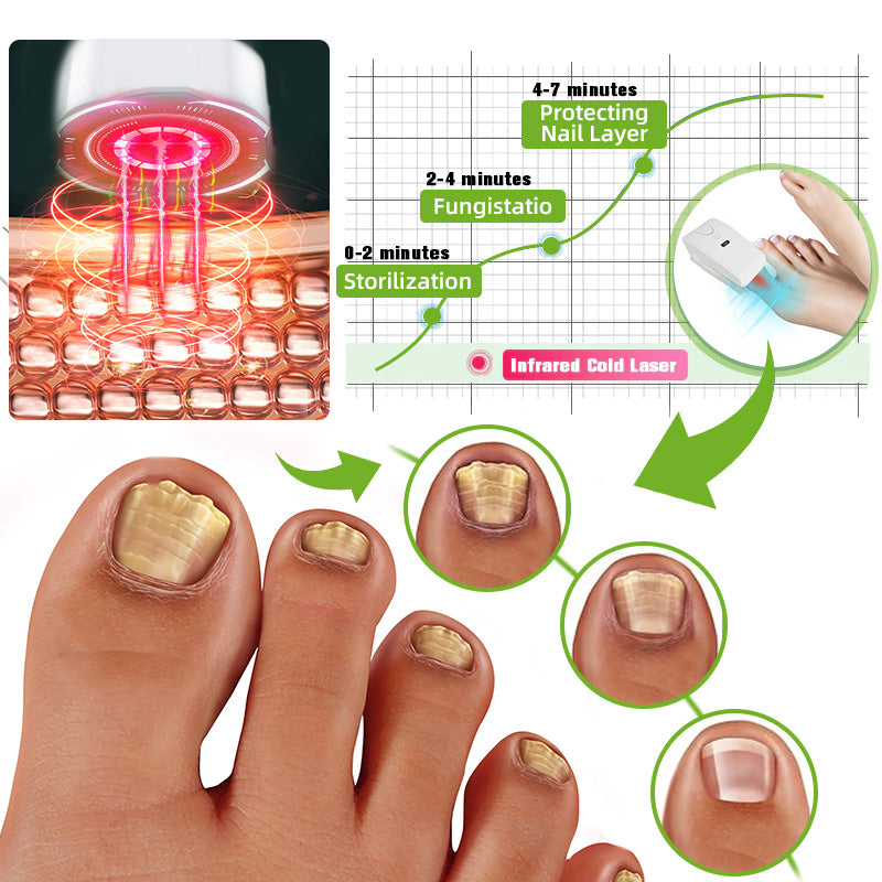 Nail Fungus Laser Treatment Device