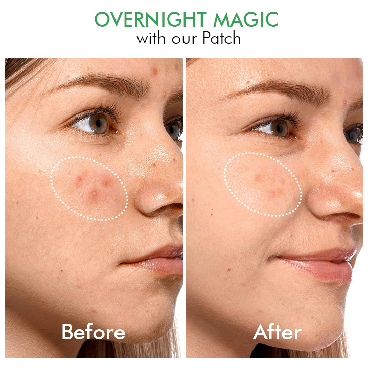 Overnight Hydrocolloid Acne Clear Patches