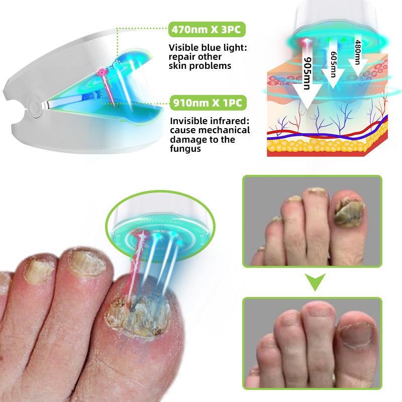 Nail Fungus Laser Treatment Device