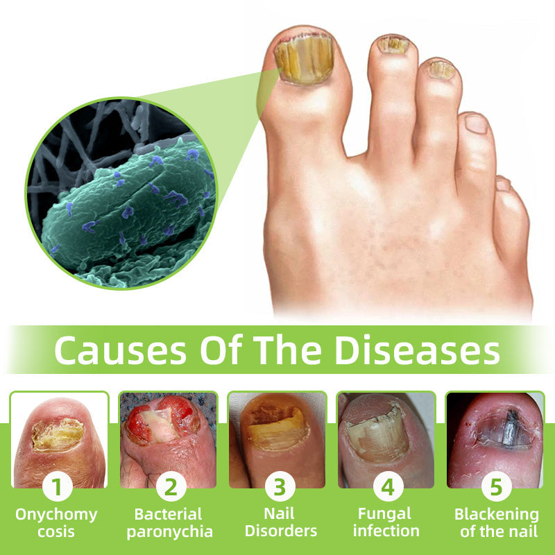 Nail Fungus Laser Treatment Device