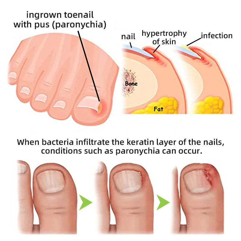 Nail Fungus Laser Treatment Device