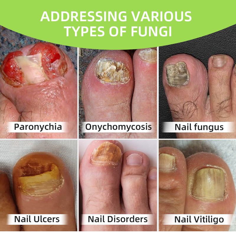 Nail Fungus Laser Treatment Device