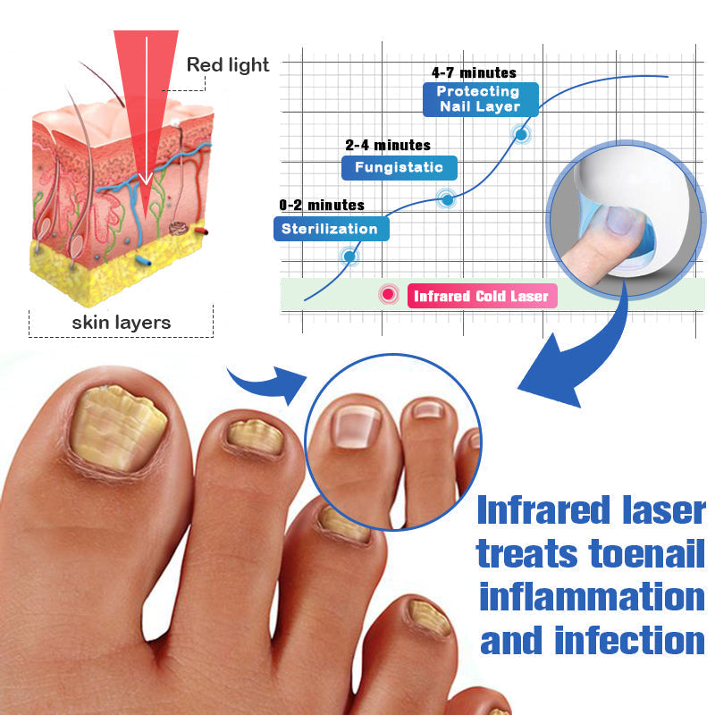 Nail Fungus Cleaning Laser Relief Device